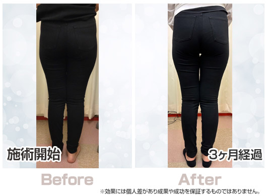 【ビフォーアフター】女性：施術期間3ヶ月