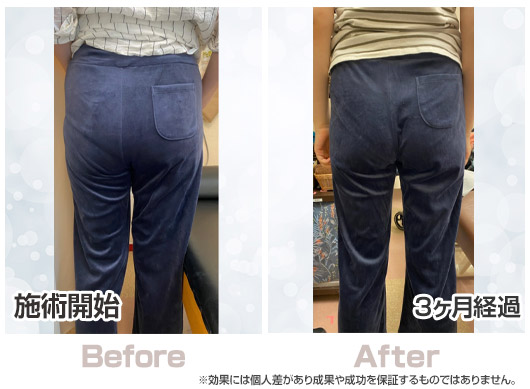 【ビフォーアフター】女性：施術期間3ヶ月